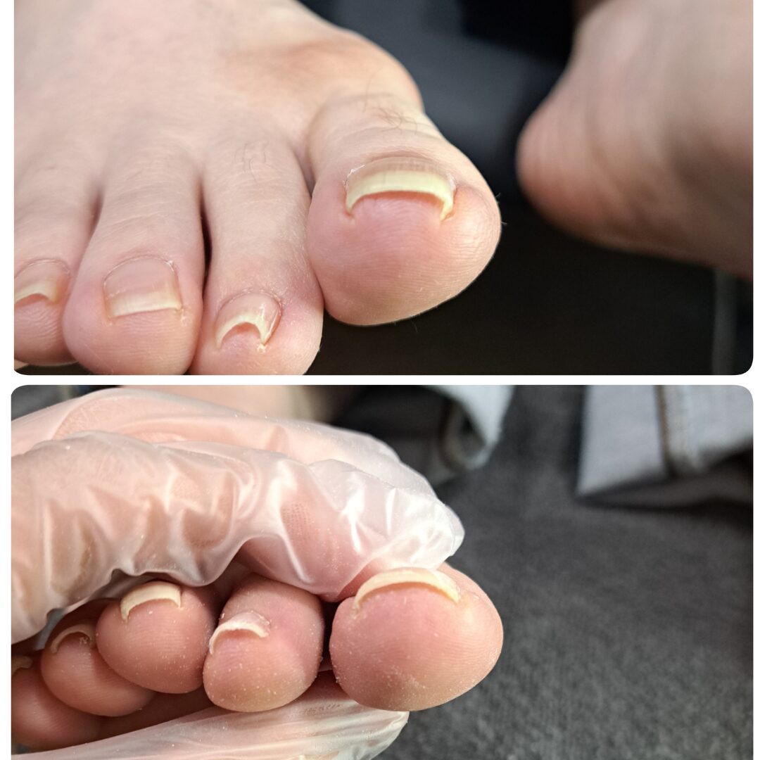 巻き爪症例③ビフォーアフター 40代男性